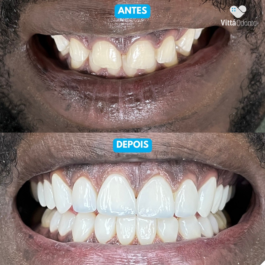 facetas-de-porcelana-vantagens-beneficios-e-tudo-o-que-voce-precisa-saber