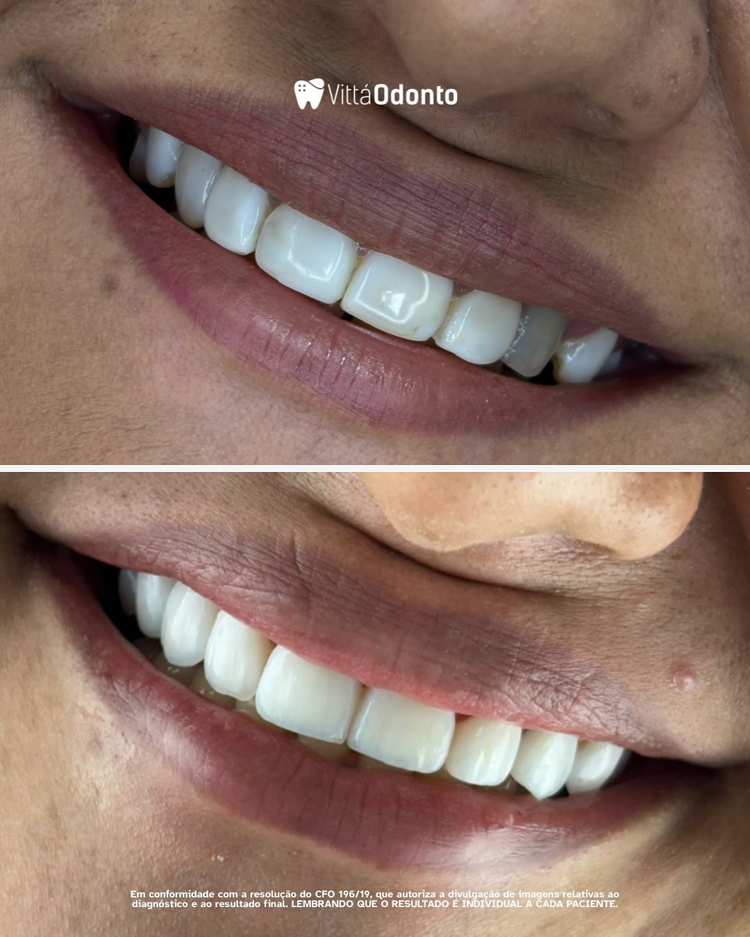 facetas-de-porcelana-vantagens-beneficios-e-tudo-o-que-voce-precisa-saber